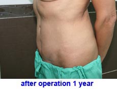 plastic-surgery-tummy-tuck