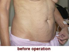 plastic-surgery-tummy-tuck