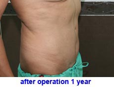 plastic-surgery-tummy-tuck