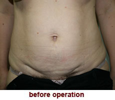 plastic-surgery-tummy-tuck