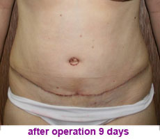 plastic-surgery-tummy-tuck