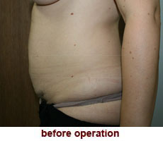 plastic-surgery-tummy-tuck