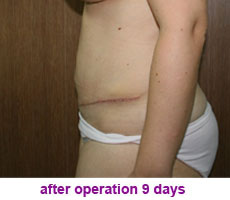 plastic-surgery-tummy-tuck