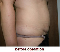 plastic-surgery-tummy-tuck