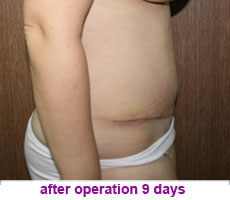 plastic-surgery-tummy-tuck