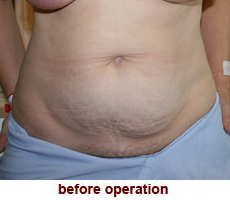 plastic-surgery-tummy-tuck