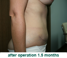 plastic-surgery-tummy-tuck