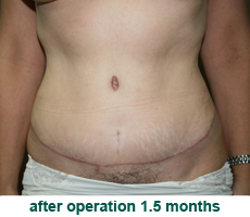 plastic-surgery-tummy-tuck