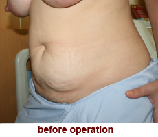 plastic-surgery-tummy-tuck