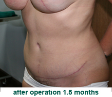 plastic-surgery-tummy-tuck