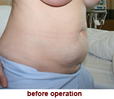 plastic-surgery-tummy-tuck