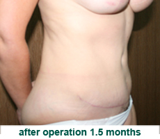 plastic-surgery-tummy-tuck