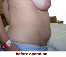 plastic-surgery-tummy-tuck