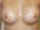 Photo Breast Surgery