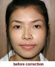 plastic_surgery_augmentation_rhinoplasty