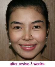 plastic_surgery_augmentation_rhinoplasty