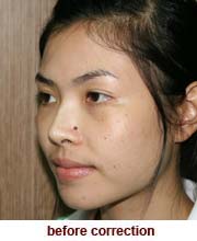 plastic_surgery_augmentation_rhinoplasty