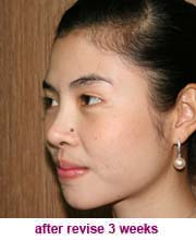 plastic_surgery_augmentation_rhinoplasty