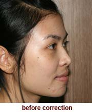 plastic_surgery_augmentation_rhinoplasty