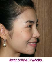 plastic_surgery_augmentation_rhinoplasty