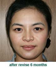 plastic_surgery_augmentation_rhinoplasty