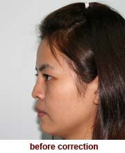 plastic_surgery_augmentation_rhinoplasty