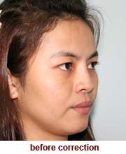 plastic_surgery_augmentation_rhinoplasty