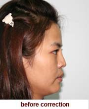 plastic_surgery_augmentation_rhinoplasty