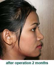 plastic_surgery_augmentation_rhinoplasty