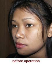 plastic_surgery_augmentation_rhinoplasty