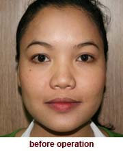 plastic_surgery_augmentation_rhinoplasty