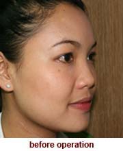 plastic_surgery_augmentation_rhinoplasty