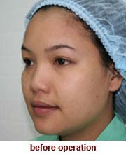 plastic_surgery_augmentation_rhinoplasty