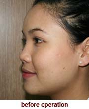 plastic_surgery_augmentation_rhinoplasty