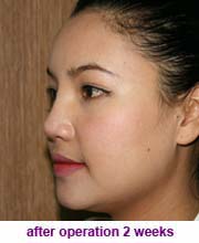 plastic_surgery_augmentation_rhinoplasty