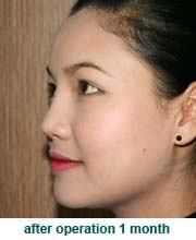 plastic_surgery_augmentation_rhinoplasty