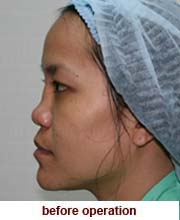 plastic_surgery_augmentation_rhinoplasty