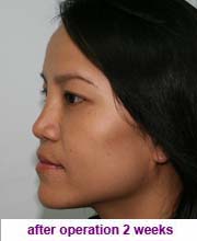 plastic_surgery_augmentation_rhinoplasty