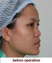 plastic_surgery_augmentation_rhinoplasty