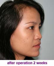 plastic_surgery_augmentation_rhinoplasty