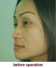 plastic_surgery_augmentation_rhinoplasty