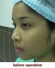 plastic_surgery_augmentation_rhinoplasty