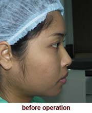 plastic_surgery_augmentation_rhinoplasty