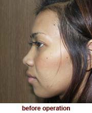 plastic_surgery_augmentation_rhinoplasty