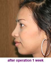 plastic_surgery_augmentation_rhinoplasty