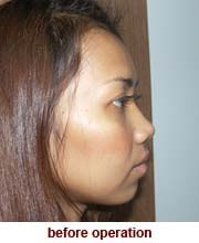 plastic_surgery_augmentation_rhinoplasty