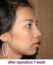 plastic_surgery_augmentation_rhinoplasty