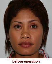 plastic_surgery_augmentation_rhinoplasty