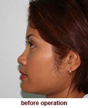 plastic_surgery_augmentation_rhinoplasty