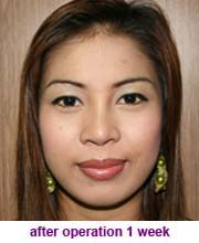 plastic_surgery_augmentation_rhinoplasty